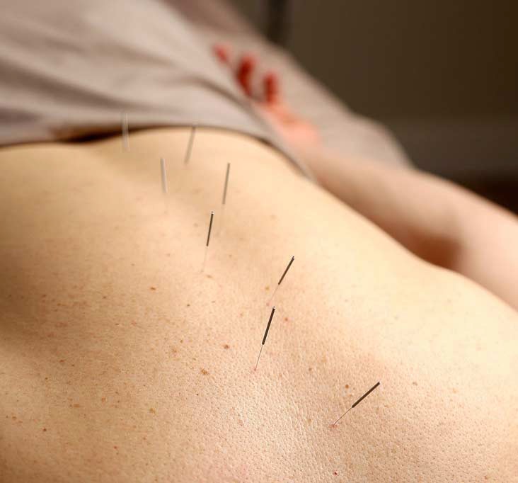 Acupuncture Treatments In Cottonwood Heights