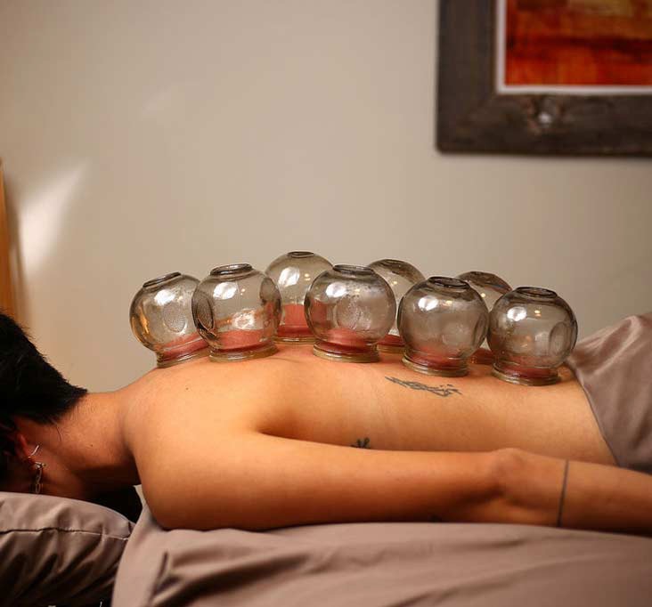 Cottonwood Heights Cupping Specialist Treatment