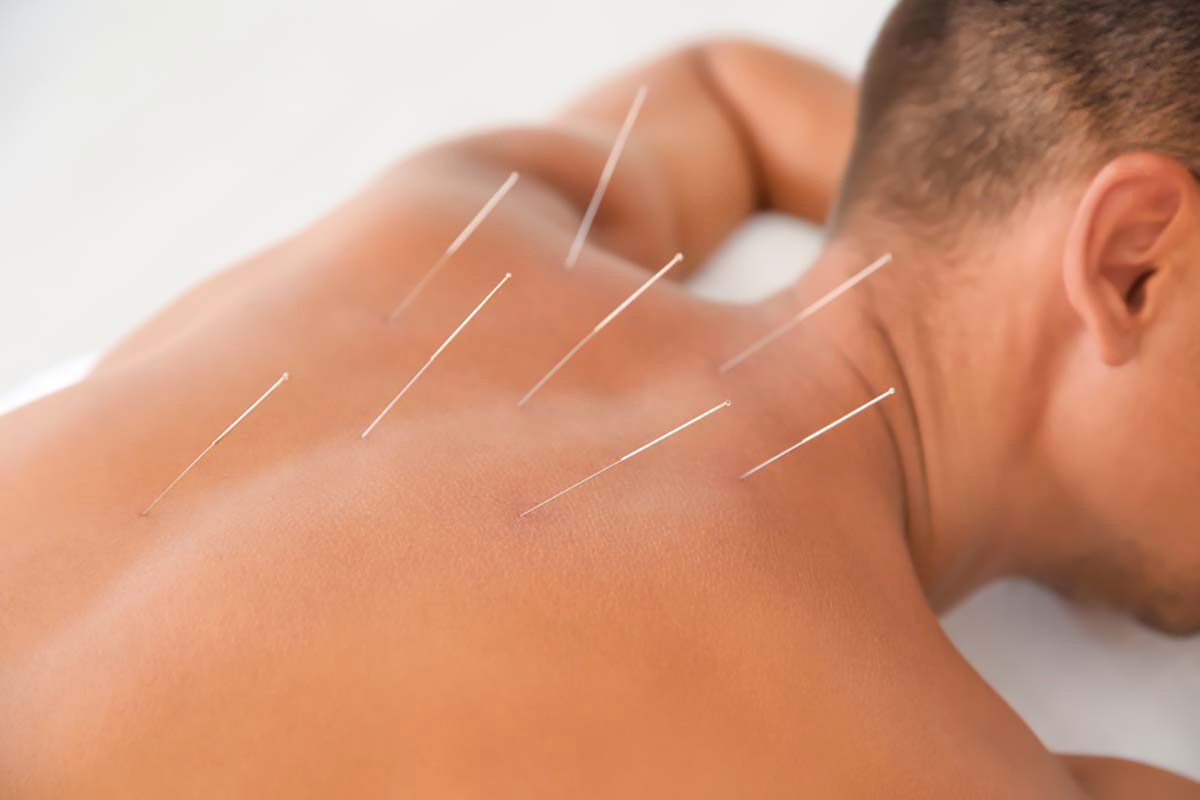 Acupuncture Clinic for back pain relief near me in Holladay