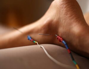 dry needling versus acupuncture in salt lake city