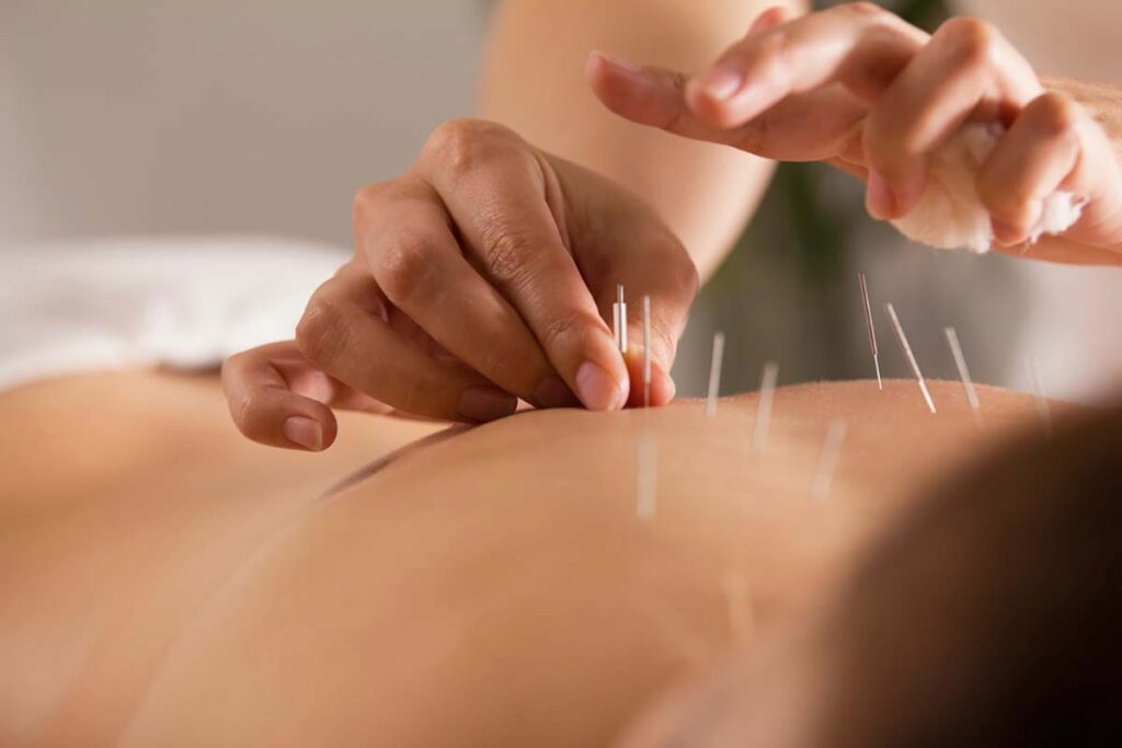 Pain Relief With Acupuncture In Millcreek Utah