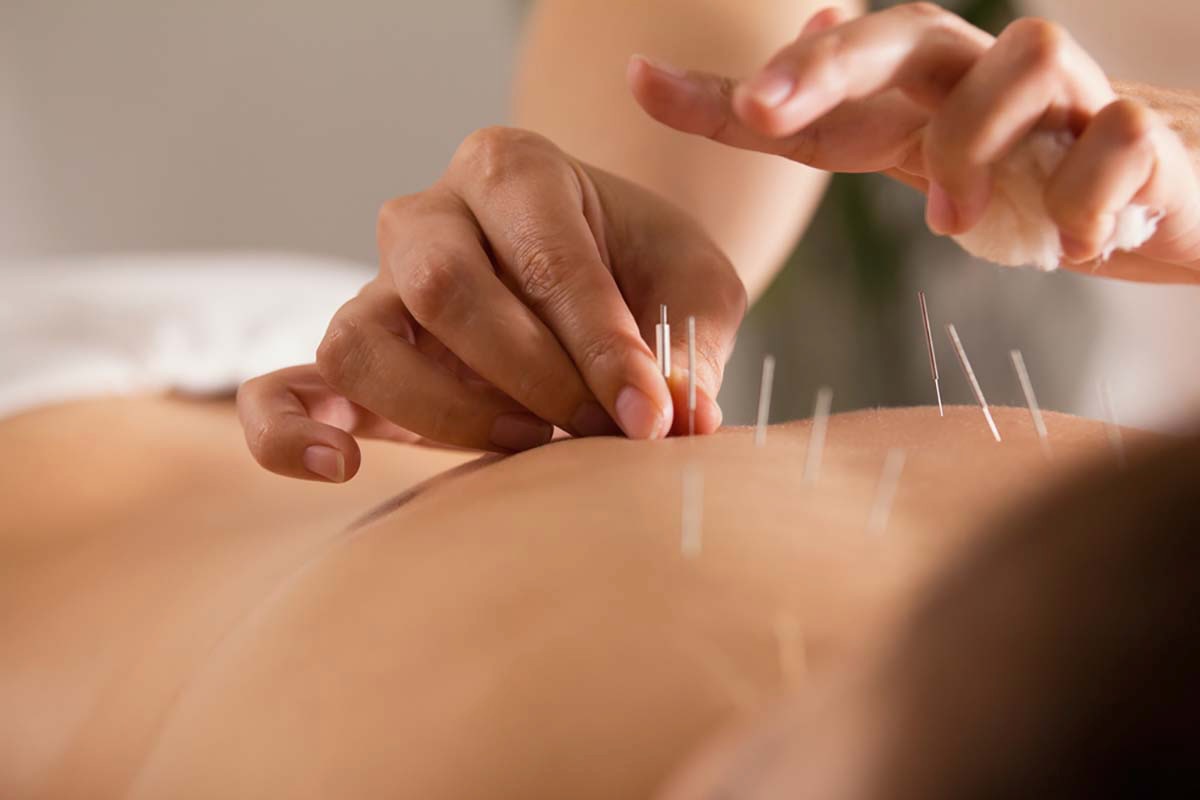 Pain Relief With Acupuncture In Millcreek Utah